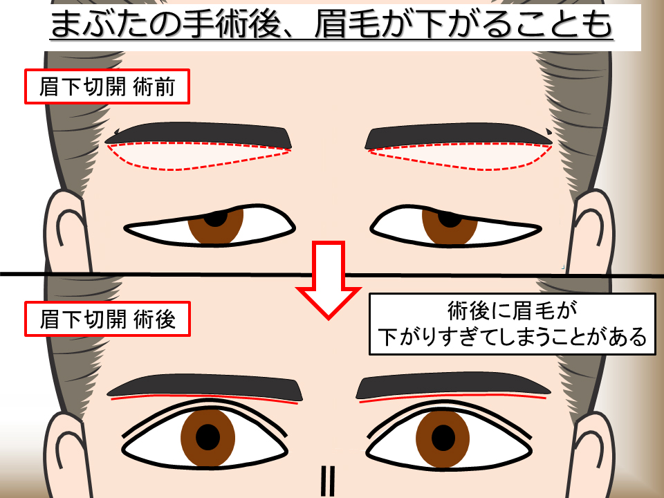 まぶたの手術後、眉毛が下がることも