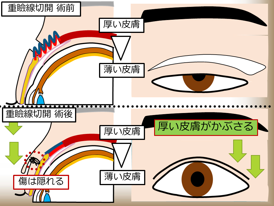 重瞼線切開 術前/術後