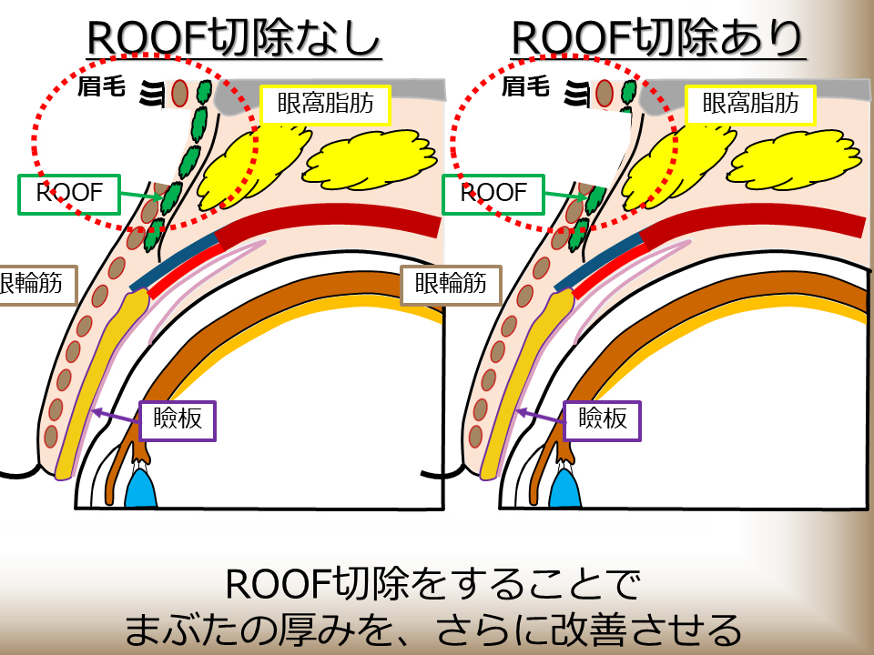 ROOF切除をすることでまぶたの厚みをさらに改善させる