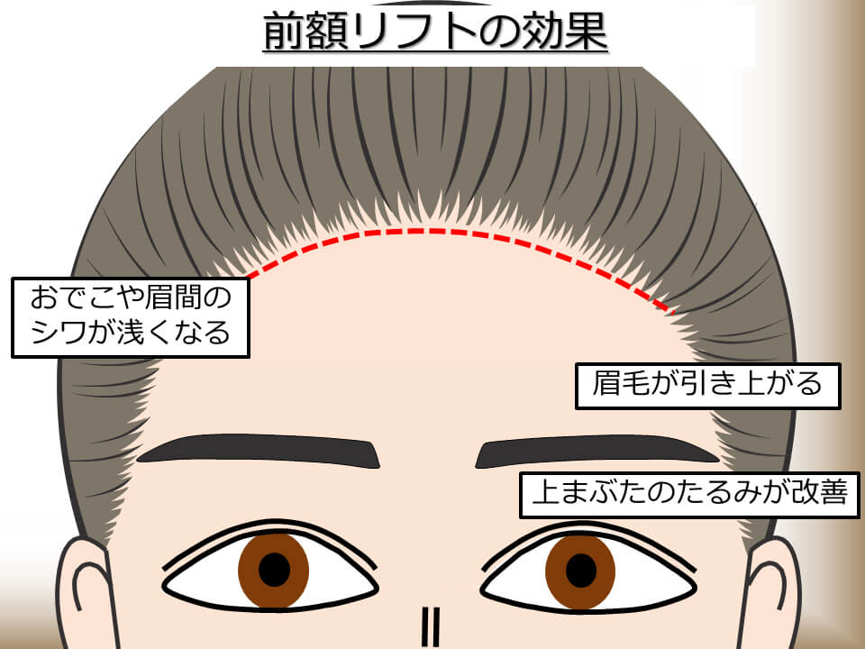 前額リフトの効果