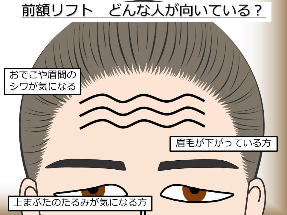 前額リフトはどんな人に向いている?