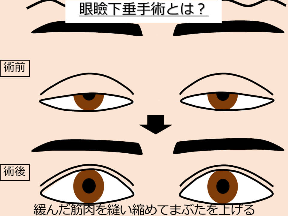 眼瞼下垂手術とは?