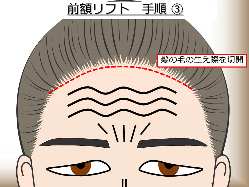 前額リフト 手順