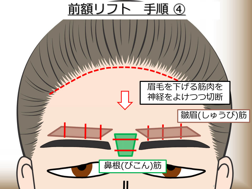 前額リフト 手順