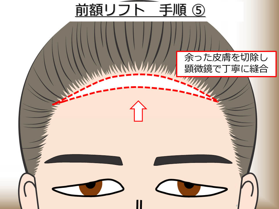 前額リフト 手順