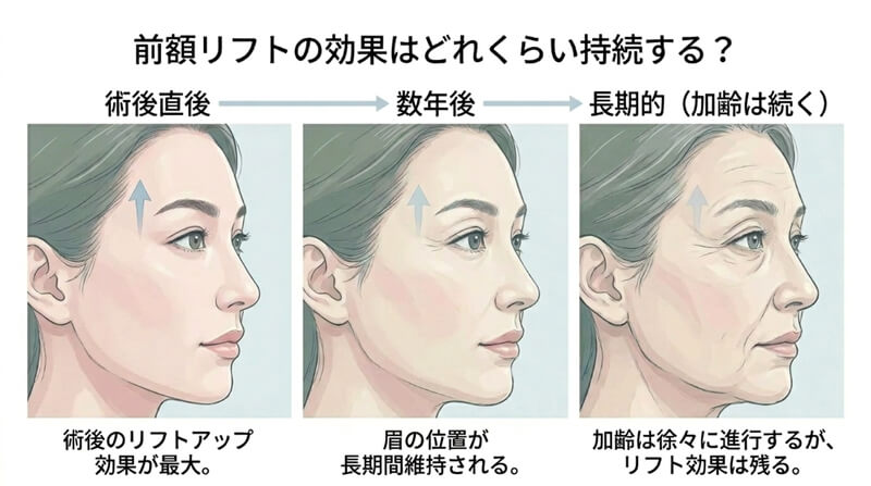 前額リフトの効果はどれくらい持続する?