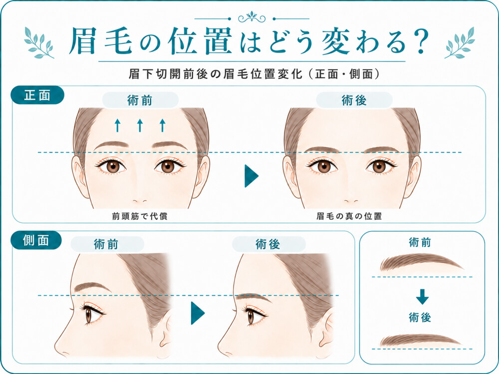 眉下切開前後の眉毛位置変化