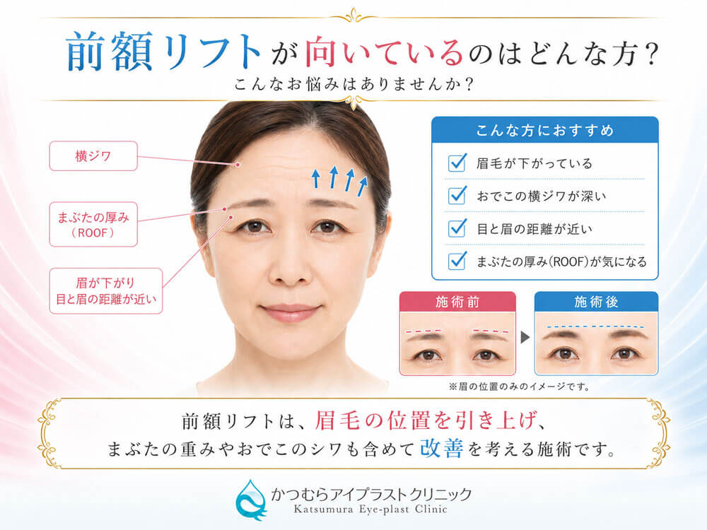 眉毛の位置を引き上げまぶたの重みやおでこのシワも含めて改善を考える施術です