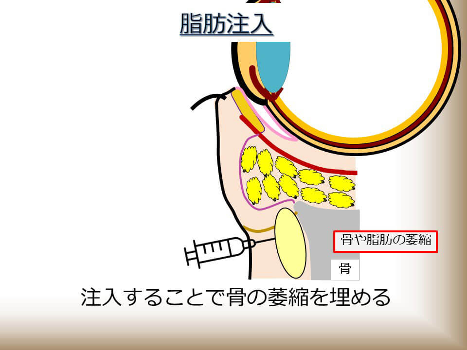 脂肪注入