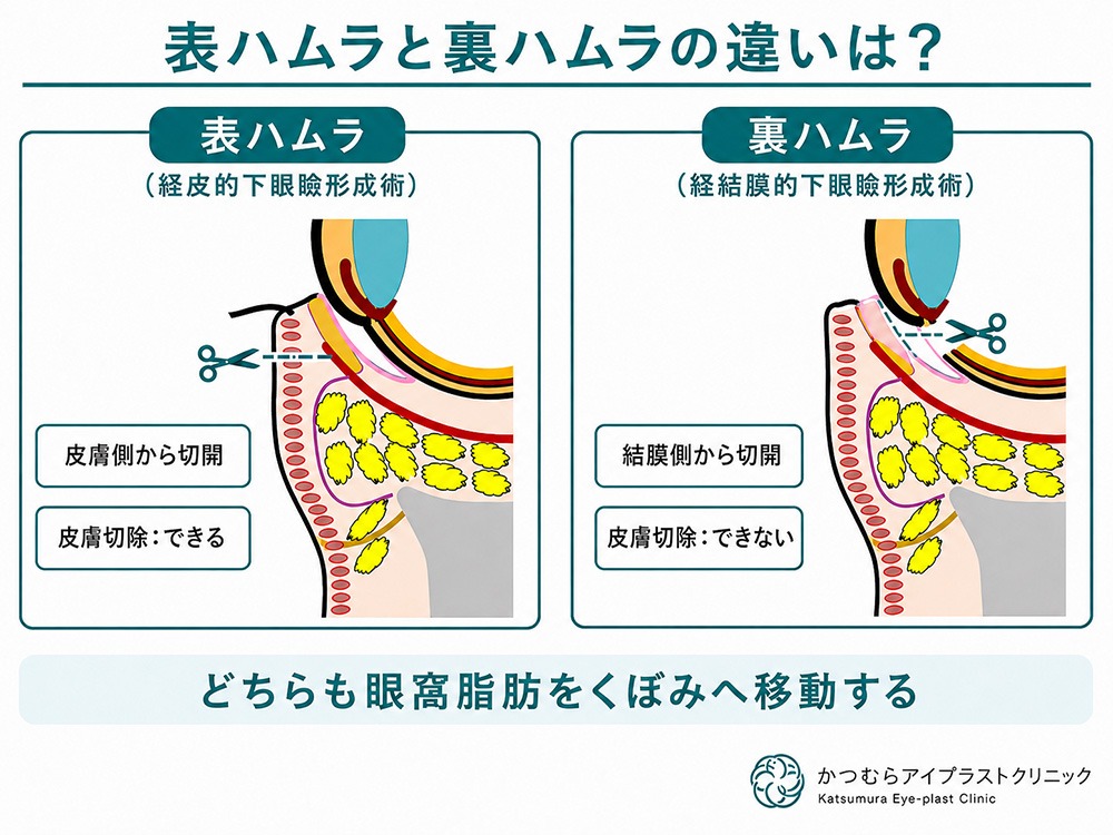 表ハムラと裏ハムラの違いは?