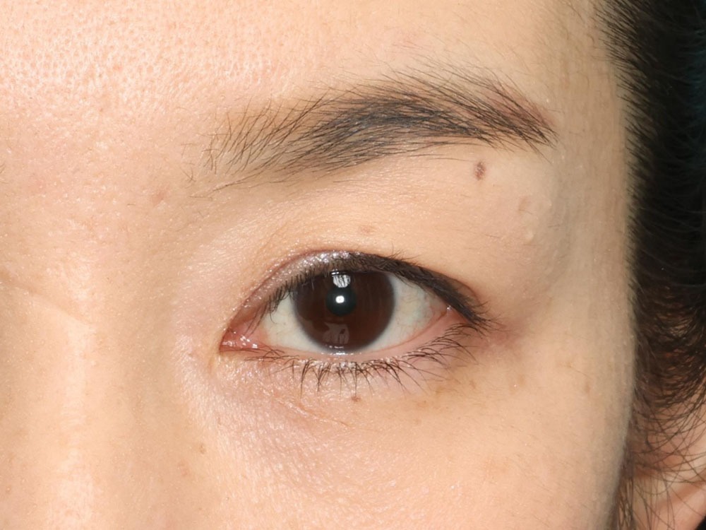 50代皮膚のたるみが中等度の場合