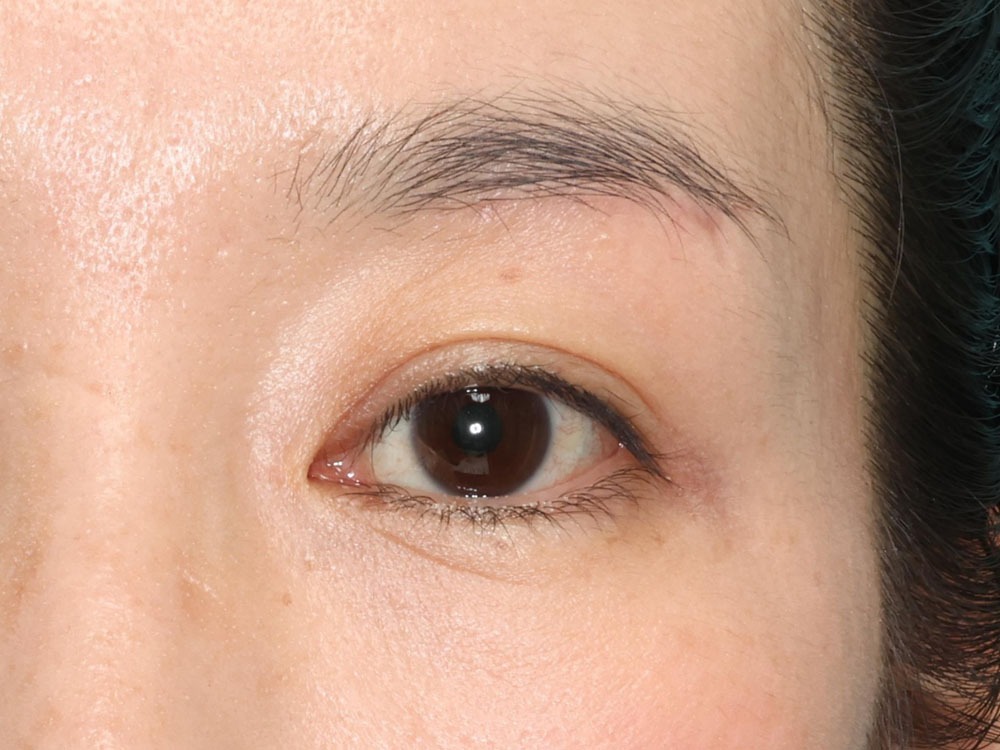 術後6カ月