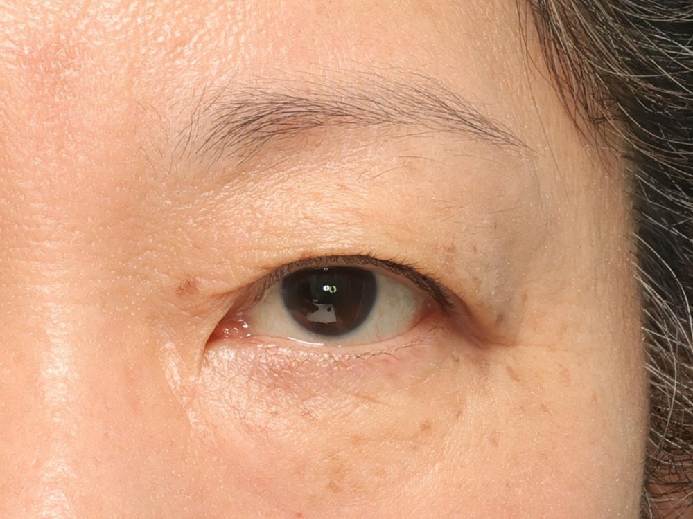 50代皮膚のたるみが中等度の場合