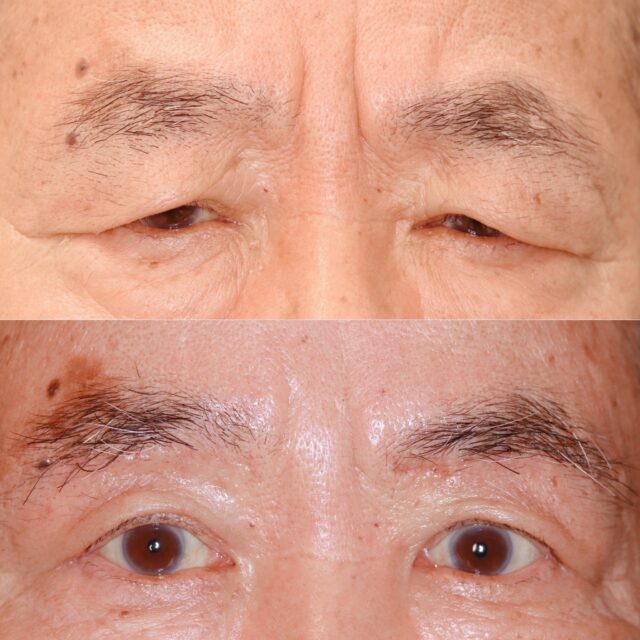 眉下切開の傷あと