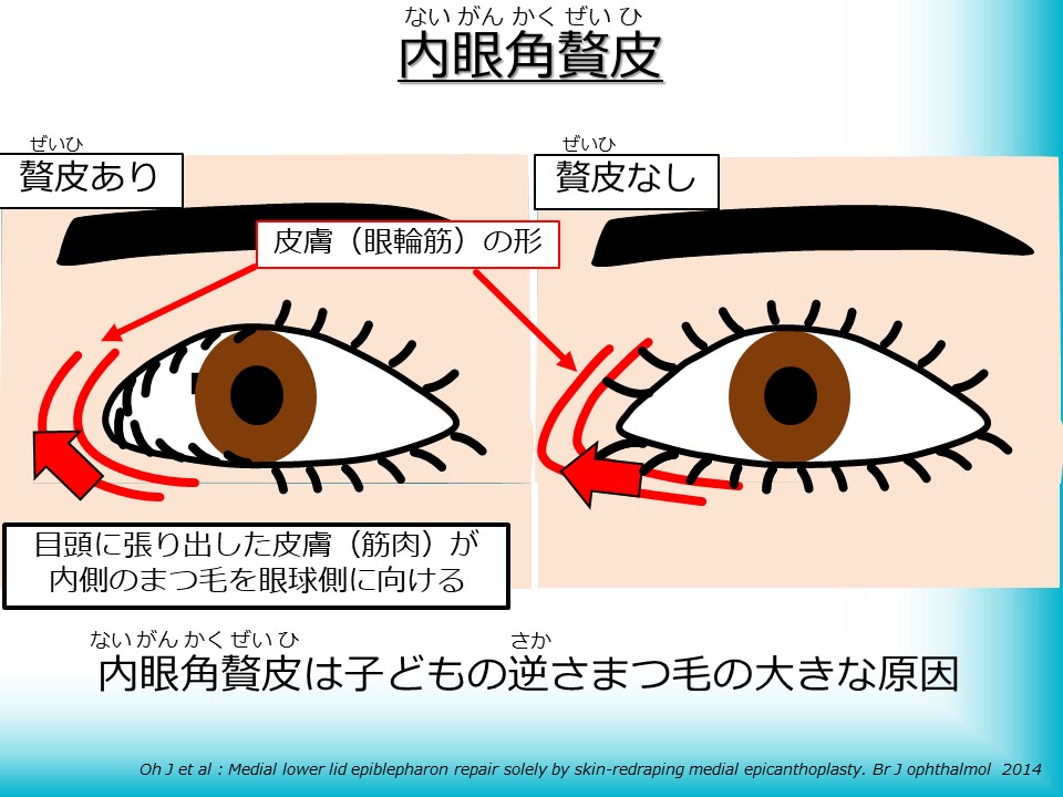 睫毛内反症 しょうもうないはんしょう 若い方の 逆さまつげ 原因 症状 治療について