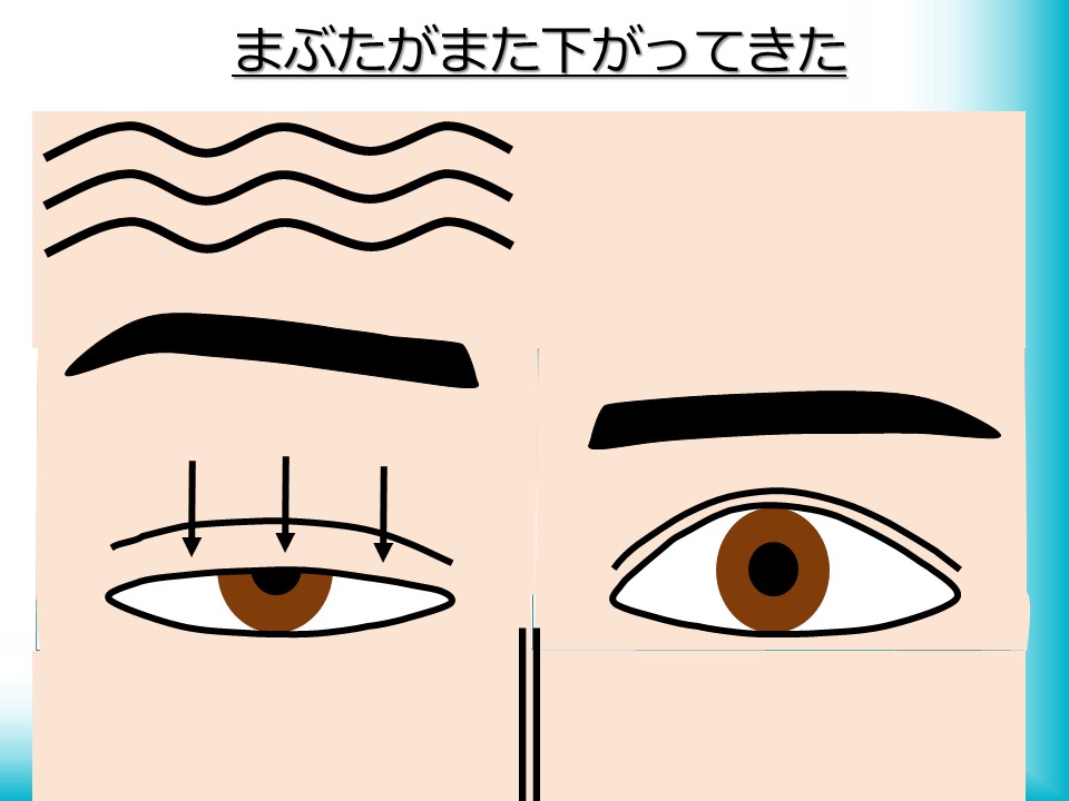 眼瞼下垂が治っていない<br />
（また下がってきた）”></figure>
</li>
<li>
<h4>まぶたのカーブがいびつである</h4>
<figure><img src=