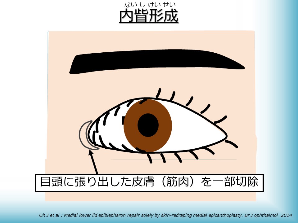 睫毛内反症 内眼角贅皮 しょうもうないはんしょう ないがんかくぜいひ 若い方の 逆さまつげ 原因 症状 治療について