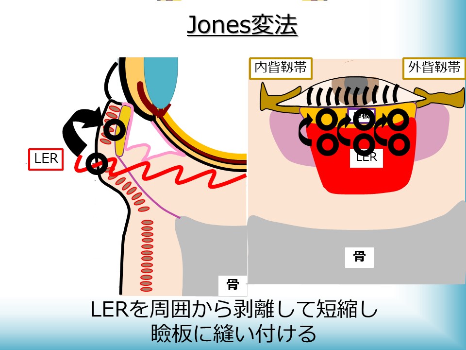 逆さまつげ・眼瞼下垂・まぶたたるみの治療・手術に対応するかつむらアイプラストクリニックのJones変法