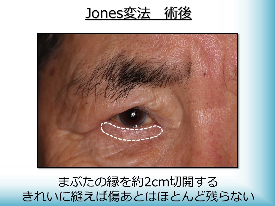 逆さまつげ・眼瞼下垂・まぶたたるみの治療・手術に対応するかつむらアイプラストクリニックのJones変法 術後