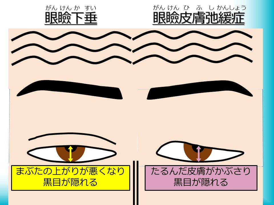 眼瞼 下垂 トレーニング