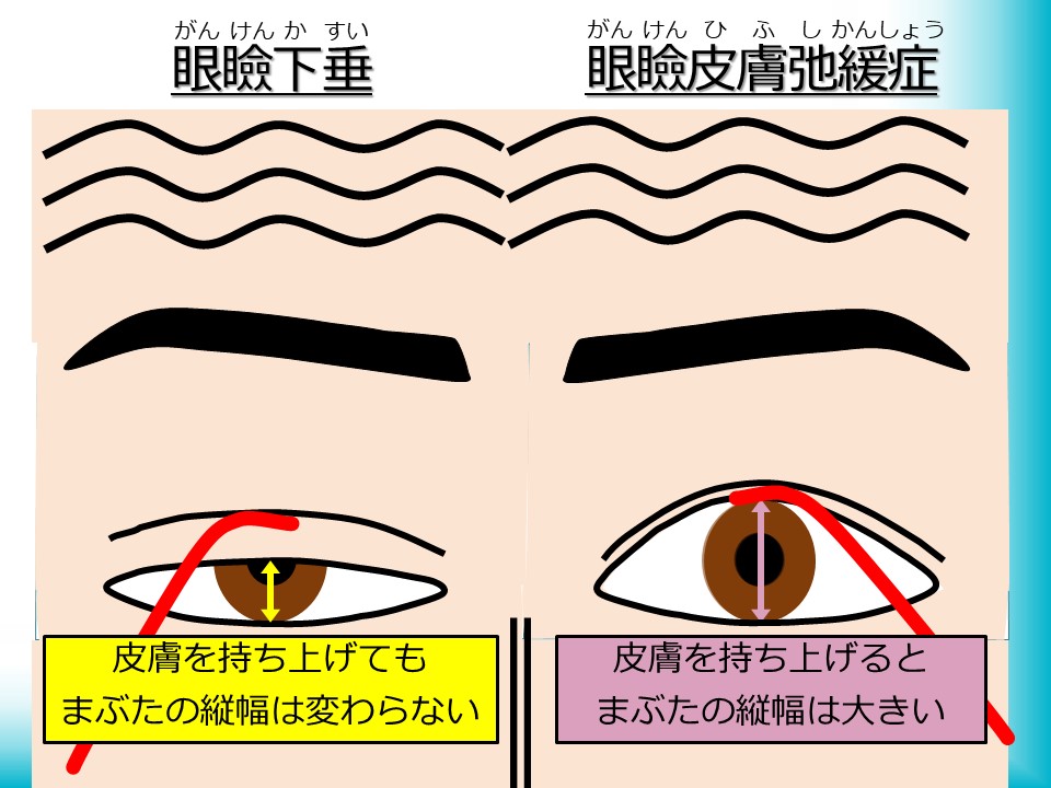 「眼瞼下垂」でよくみられる症状
