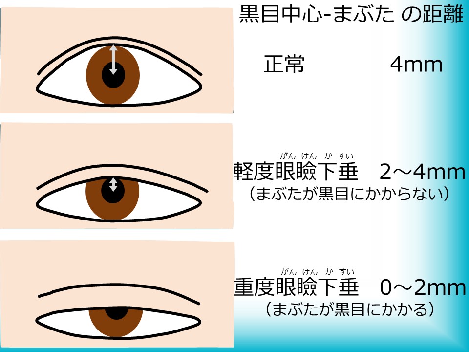 眼瞼下垂はまぶたが下がり、上方の視野が狭くなる病気です。