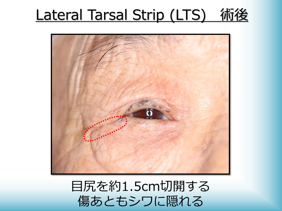 逆さまつげ・眼瞼下垂・まぶたたるみの治療・手術に対応するかつむらアイプラストクリニックのLateral Tarsal Strip(LTS) 術後