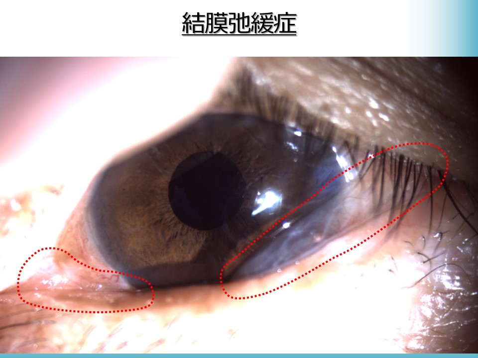 眼球が痛い ゴロゴロする 関連する疾患 原因 治療について かつむらアイプラストクリニック