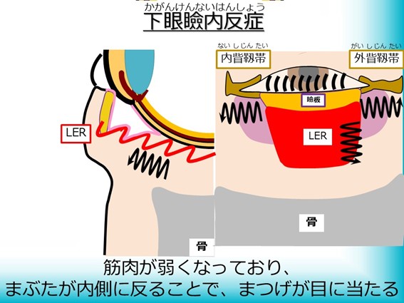 下眼瞼内反症