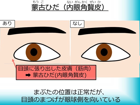 内眼角贅皮(ないがんかくぜいひ)