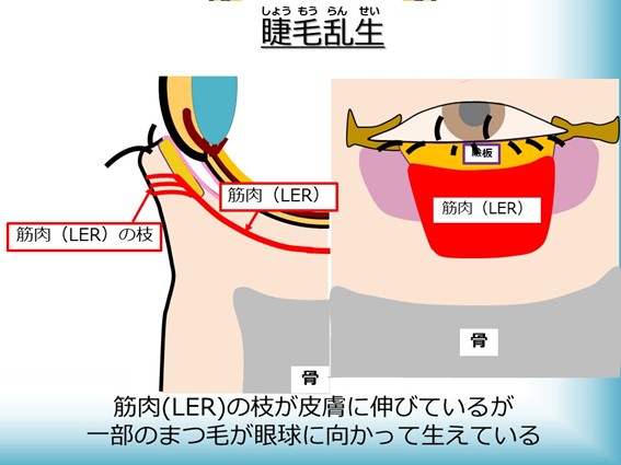 睫毛乱生症