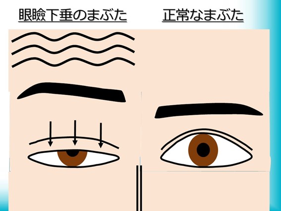 眼瞼下垂のまぶた・正常なまぶた
