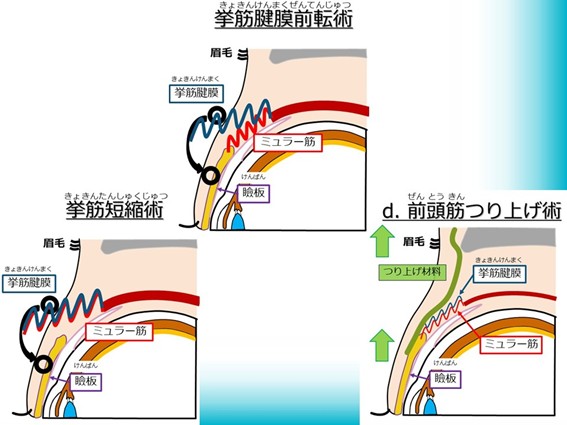 挙筋腱膜前転術・挙筋短縮術・前頭筋つりあげ術
