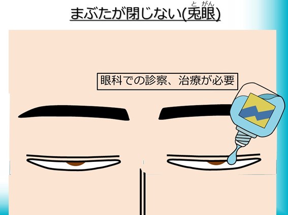 まぶたが閉じない（兎眼）