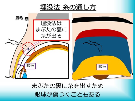 埋没法　糸の通し方