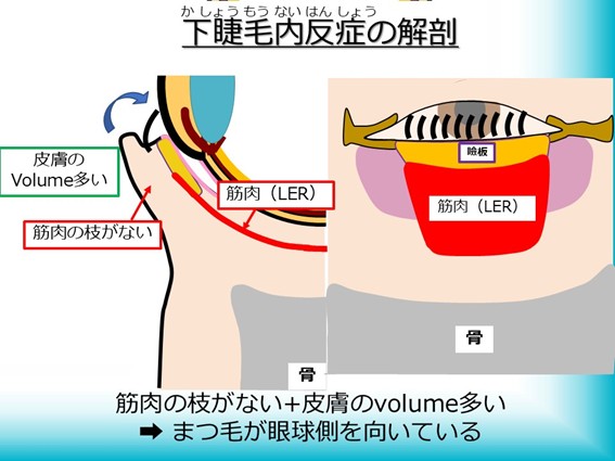下睫毛内反症の解剖