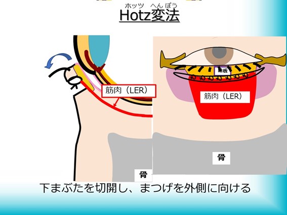 Hotz変法