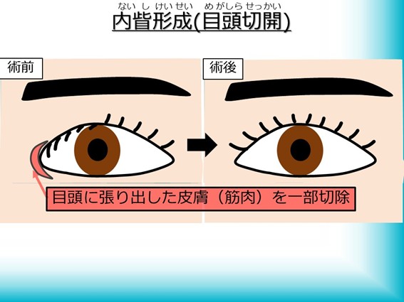 内眥形成術（目頭切開）