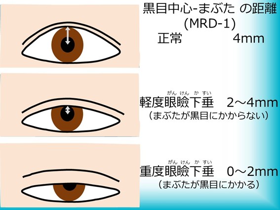 眼瞼下垂のレベル