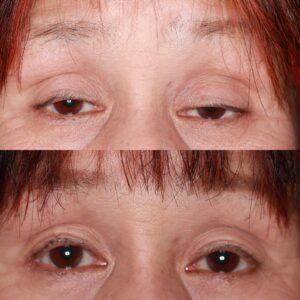 まぶたの窪みと眼瞼下垂の症例写真