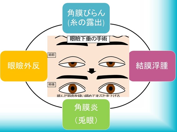 眼瞼下垂の手術