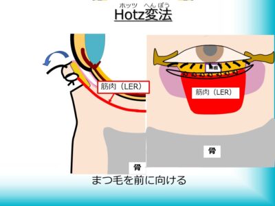 Hotz変法
