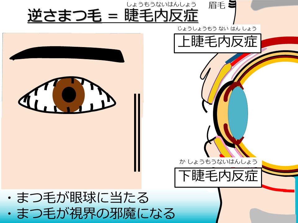 逆さまつ毛＝睫毛内反症