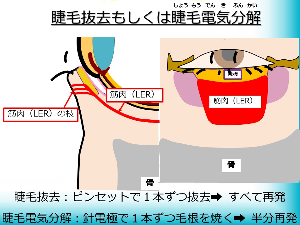睫毛抜去もしくは睫毛電気分解