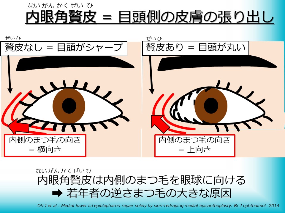 内眼角贅皮＝目頭側の皮膚の張り出し
