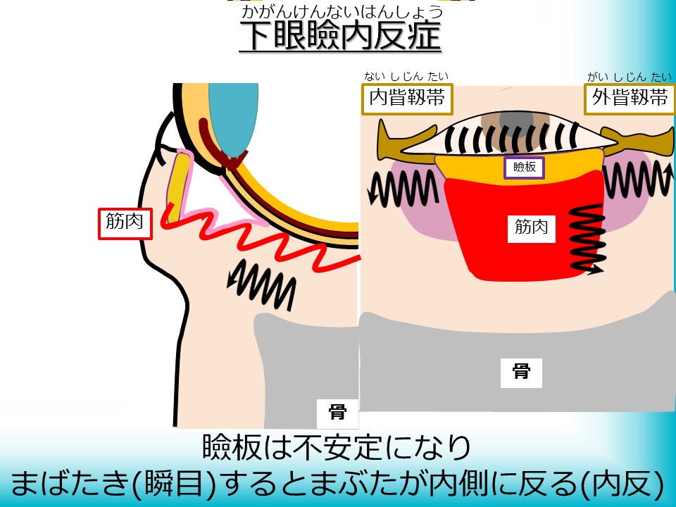 下眼瞼内反症