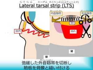 Lateral Tarsal Strip(LTS)