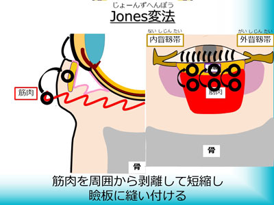 Jones変法