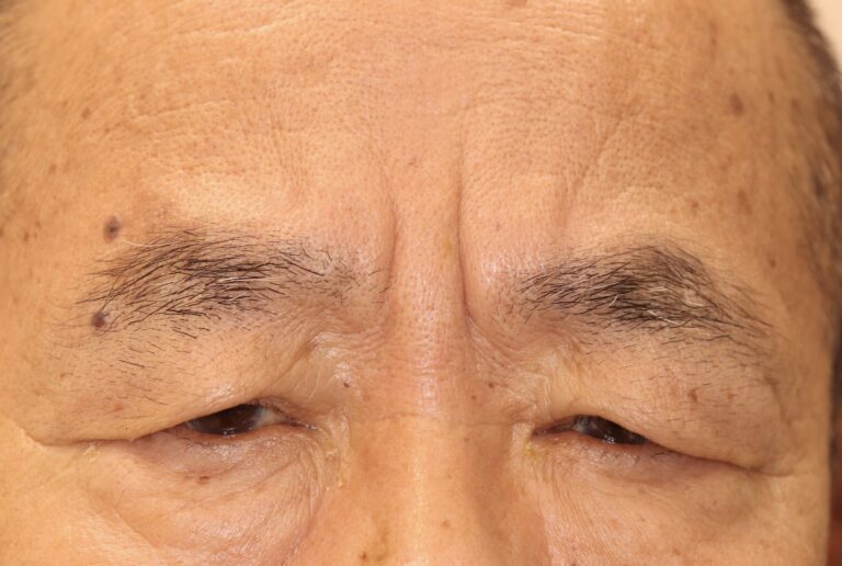 眼瞼皮膚弛緩
