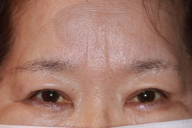 眼瞼下垂手術の傷あと
